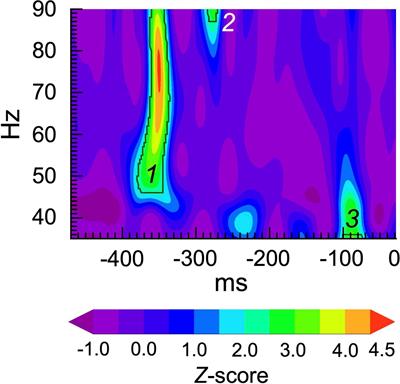 The contribution of gamma bursting to spontaneous gamma activity in schizophrenia